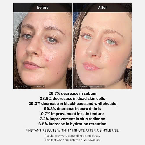 Medicube Red Acne Succinic Acid Peel 40g